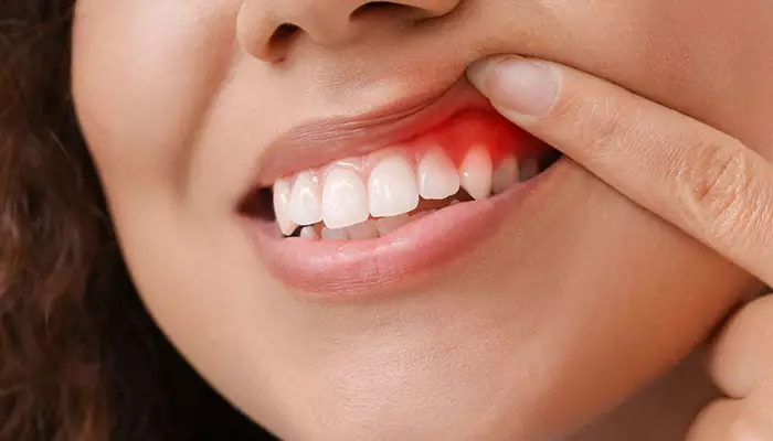 جلوگیری از بیماری های لثه با نخ دندان