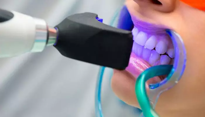 بلیچینگ از روش های اصلاح طرح لبخند