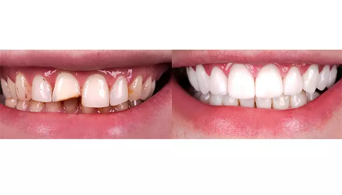 ترمیم لب پریدگی و شکستگی دندان