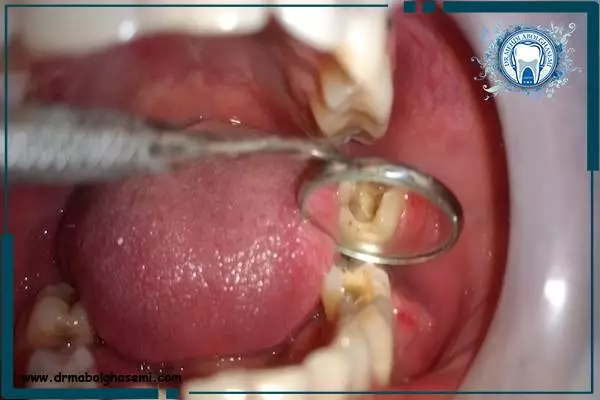 سوراخ شدن دندان و دلایل آن