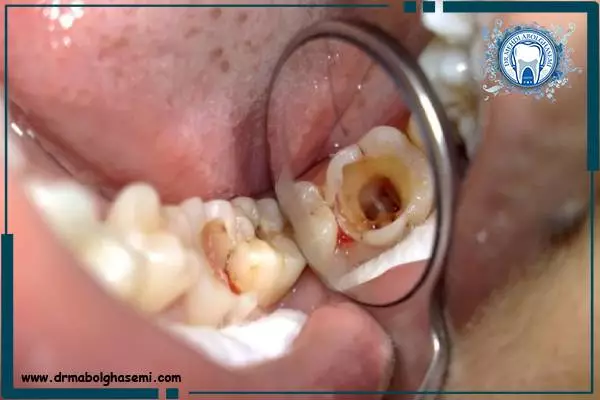 علائم سوراخ شدن دندان