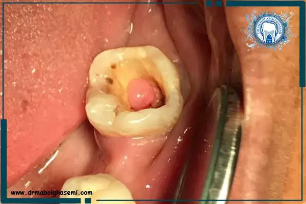 راه های درمان سوراخ شدن دندان