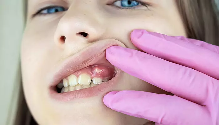 علت عفونت دندان