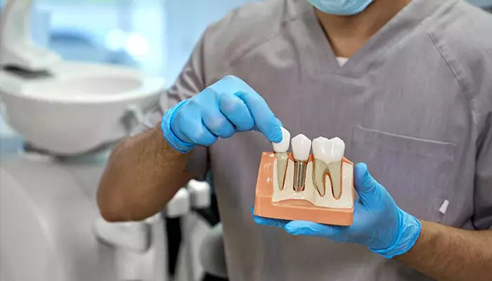 بهترین مارک ایمپلنت چیست