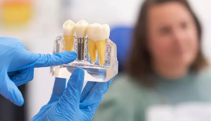 انواع برند ایمپلنت دندان