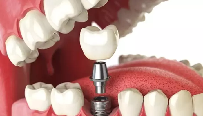 رایج ترین انواع برند ایمپلنت