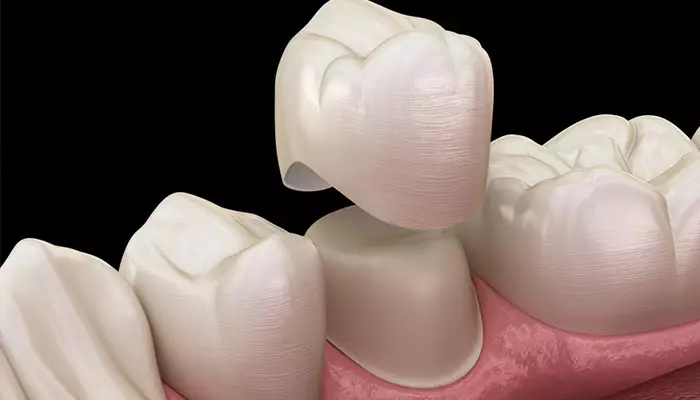 ترمیم دندان با روکش