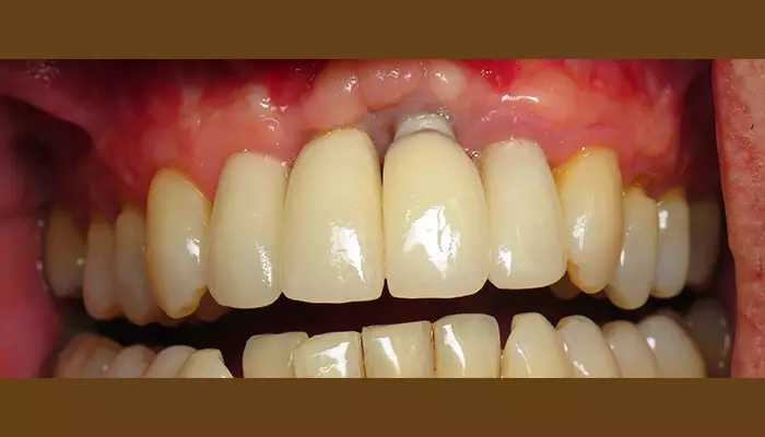 دلیل شکستن ایمپلنت دندان بیماران دیابتی