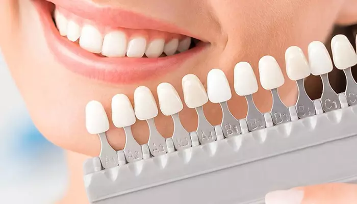 انواع لمینت دندان