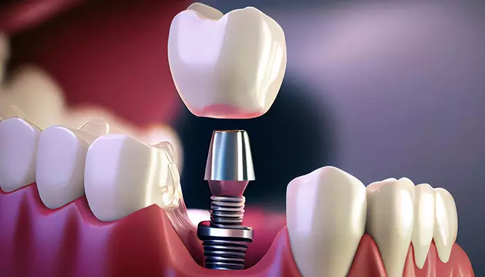 بهترین برندهای ایمپلنت دندان