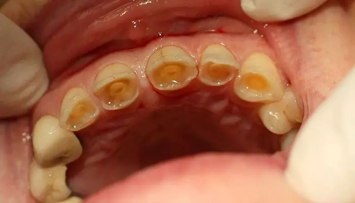 عوارض دندان براکسیسم