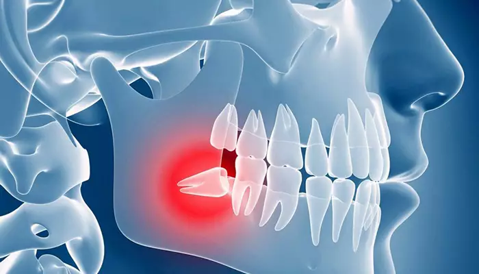 تصویری از دندان عقل