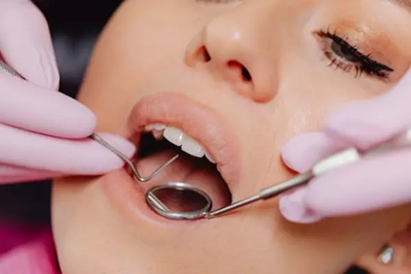 آبسه دندان عصب کشی شده