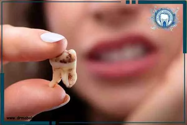 بهترین روش جلوگیری از پوسیدگی دندان