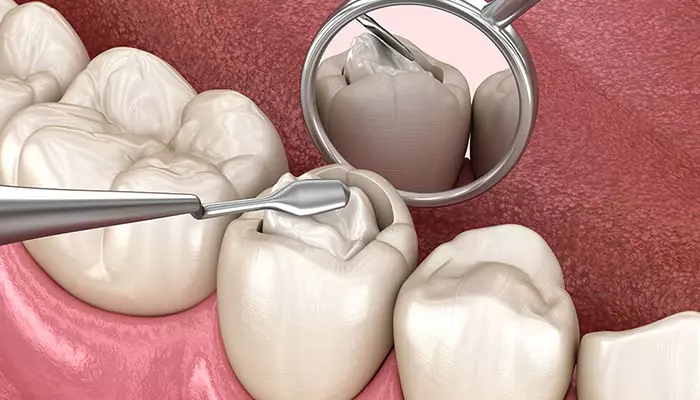 ترمیم دندان چیست