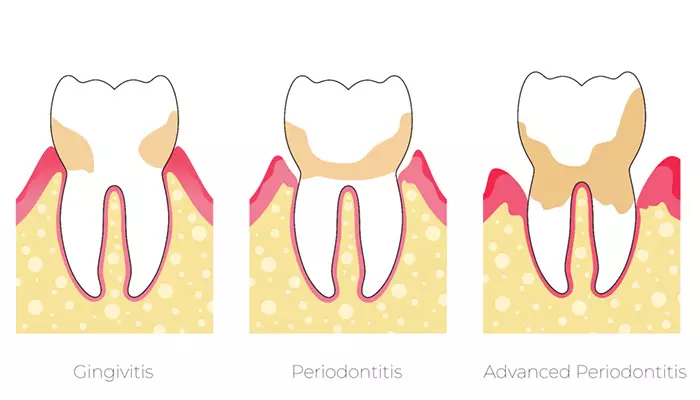 عکسی از پیشروی پریودنتیت
