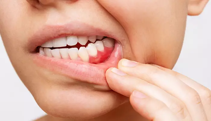  عوارض کیست دندان