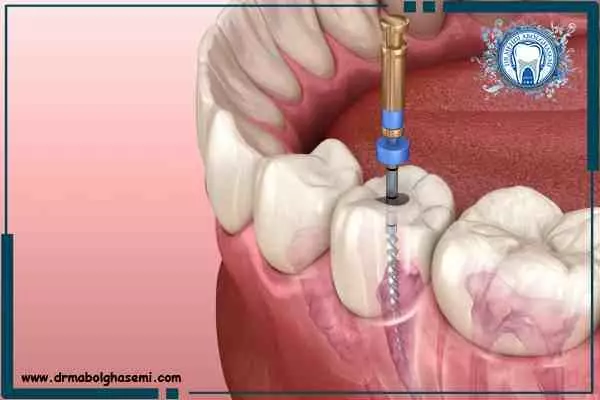 عصب کشی دندان