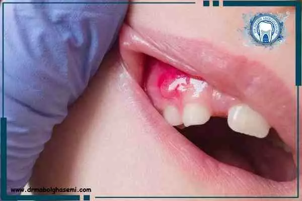 آبسه دندان چیست؟