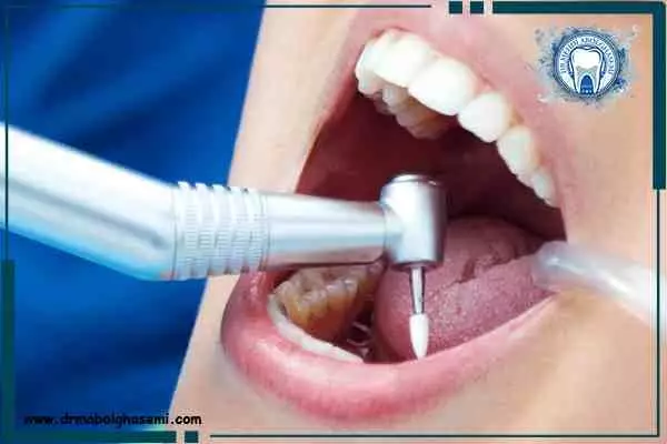 عصب کشی دندان