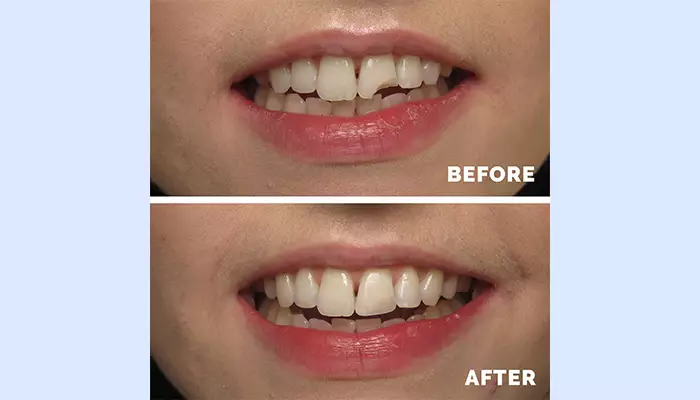 ترمیم دندان با کامپوزیت