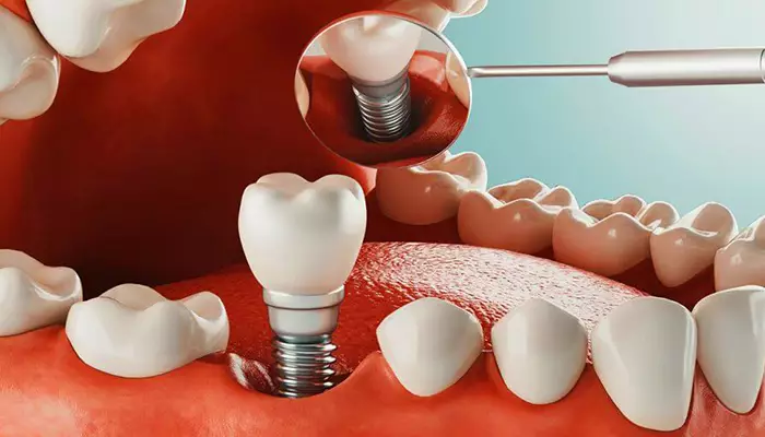 انواع روش‌های کاشت ایمپلنت برای افراد دیابتی
