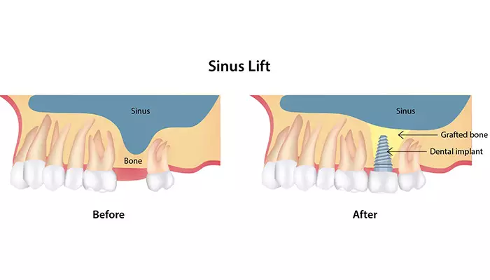 جراحی سینوس لیفت چیست