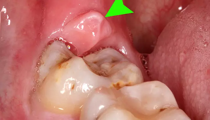 عفوننت دندان عقل