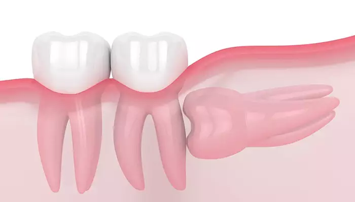 دندان عقل نهفته 