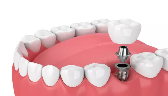 افزایش-طول-عمر-ایمپلنت-دندان2