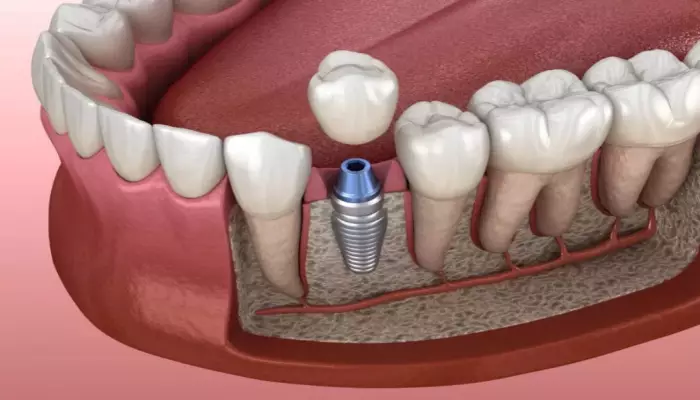 ایمپلنت کره ای دندان