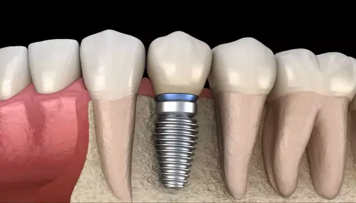 ایمپلنت-دندان