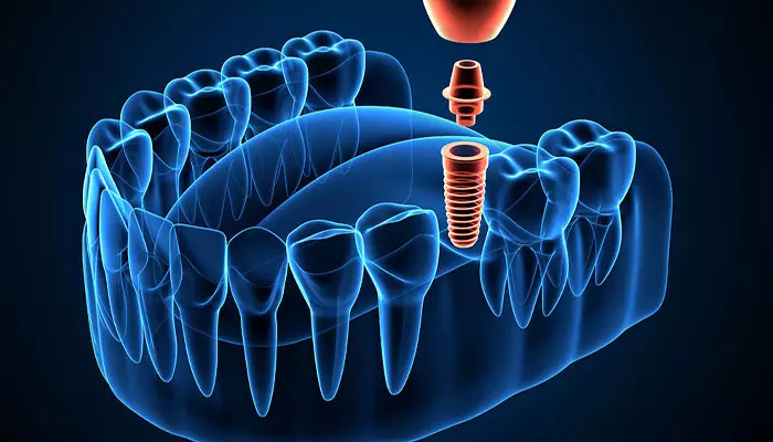 ایمپلنت-دیجیتال-1-روزه1