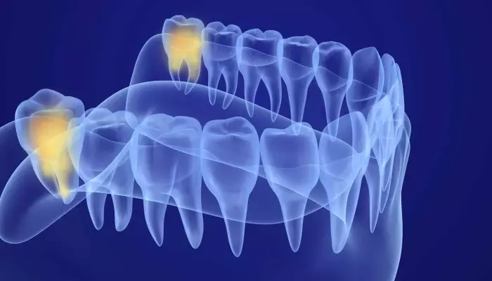 صفر تا صد دندان عقل2