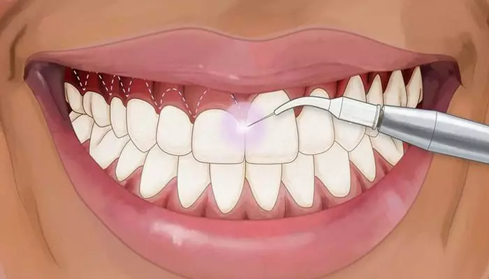 لیفت-لثه-چیست