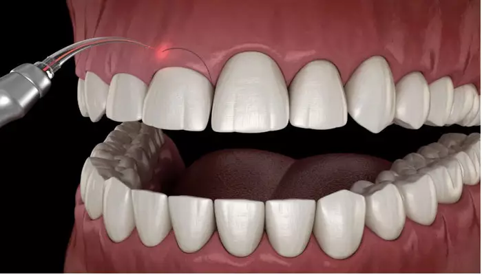 لیفت-لثه-چیست1