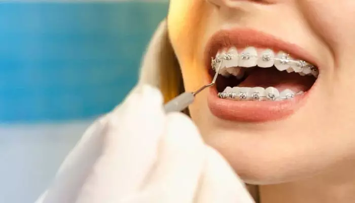 مراقبت-های-بعد-از-اورتودنسی2