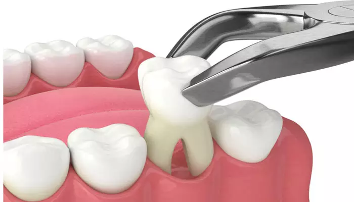 مراقبت-های-پس-از-کشیدن-دندان