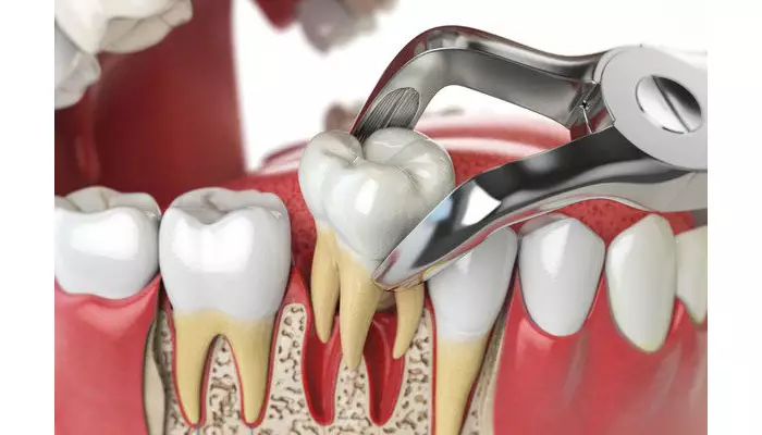 مراقبت-های-پس-از-کشیدن-دندان1