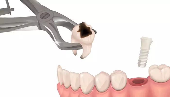 مزایا-و-معایب-ایمپلنت-دندان-تازه-خارج-شده