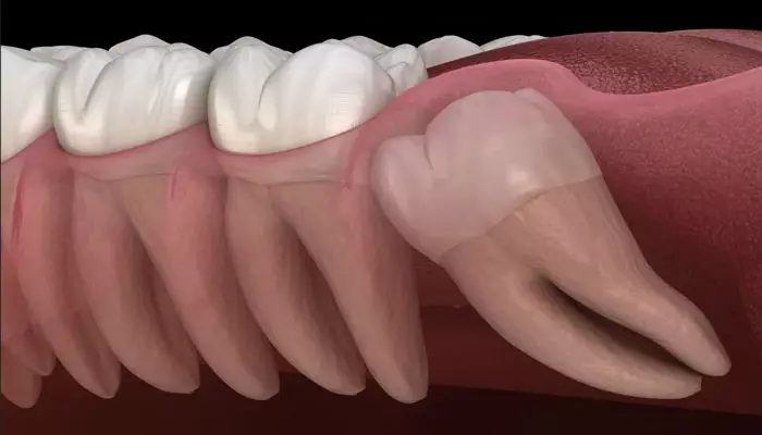 نکشیدن-دندان-عقل2