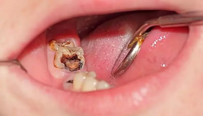 پوسیدگی دندان1