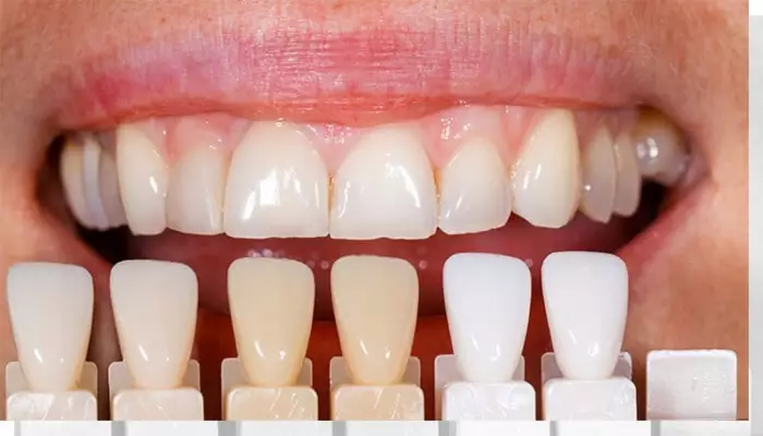 کامپوزیت ونیر