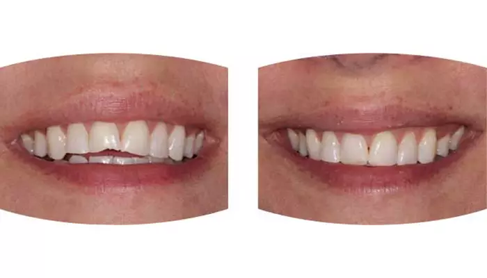 کامپوزیت دندان چیست