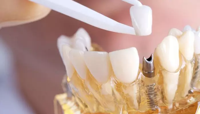 عوارض پروتز دندان