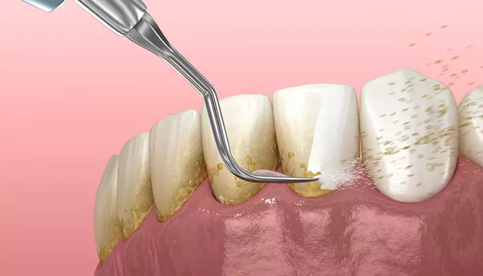 جرم گیری از مراحل ایمپلنت دندان