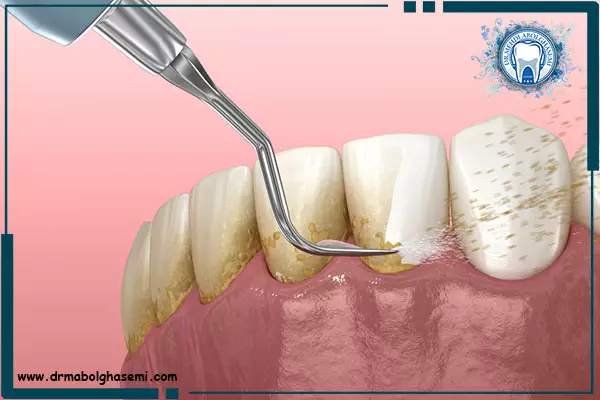 عوارض جرم گیری دندان