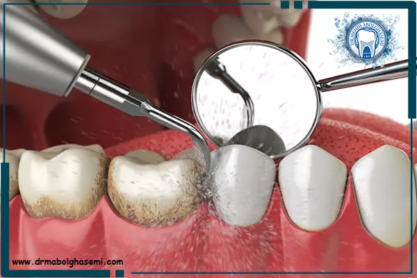 قیمت جرم گیری (بروساژ) دندان