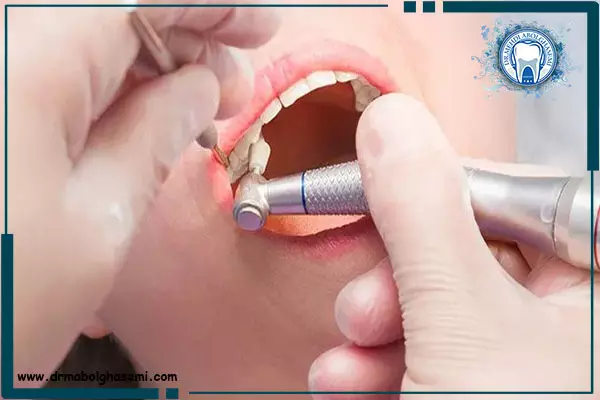 جرم گیری یا بروساژ دندان