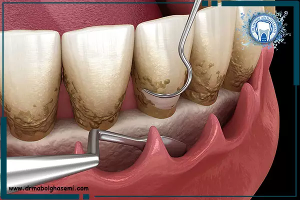 مزایای جرم گیری یا بروساژ دندان